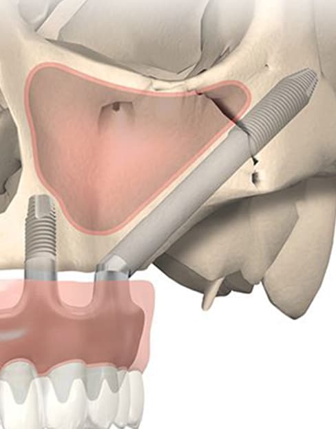 What Are Zygomatic Implants?